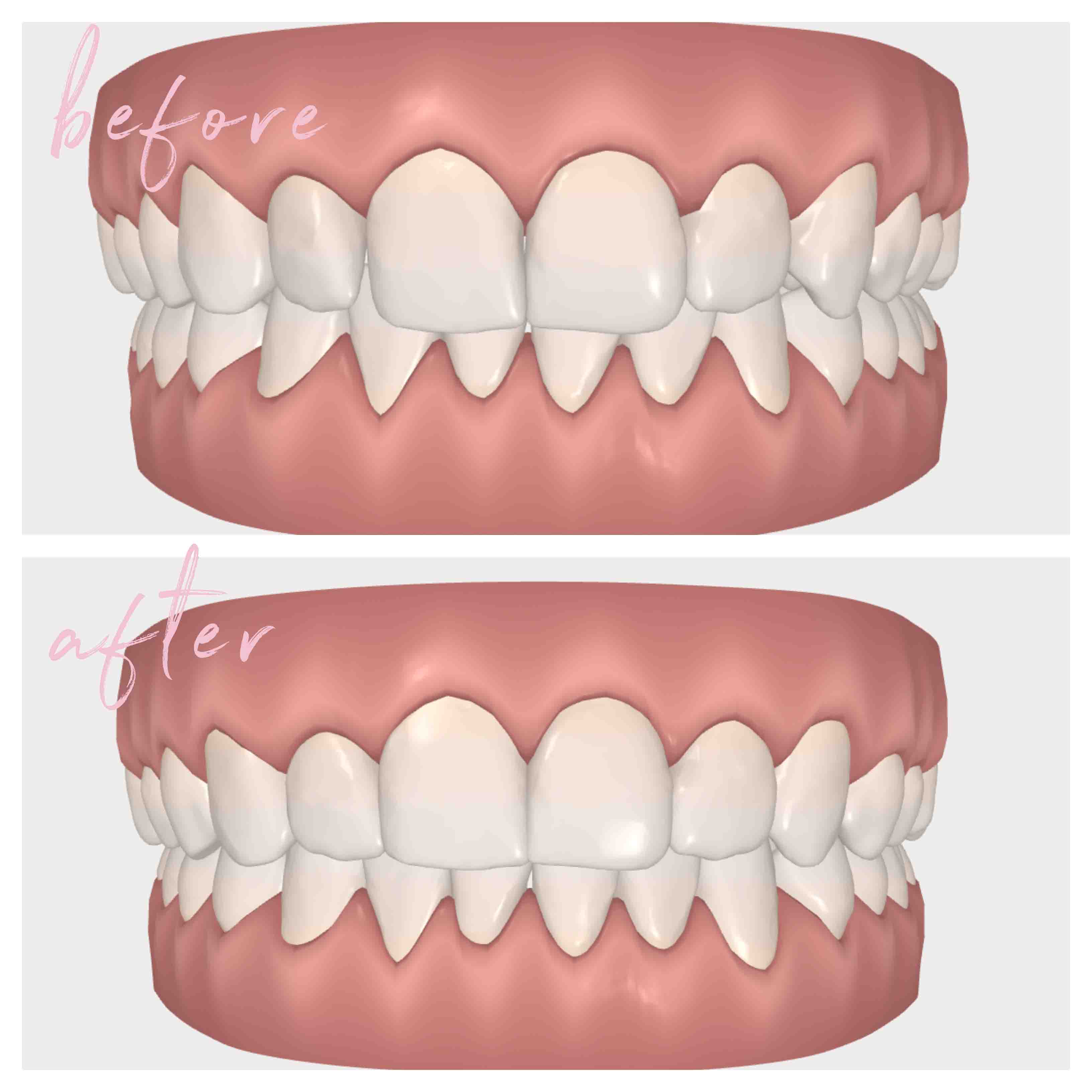 what you need to know about invisalign
