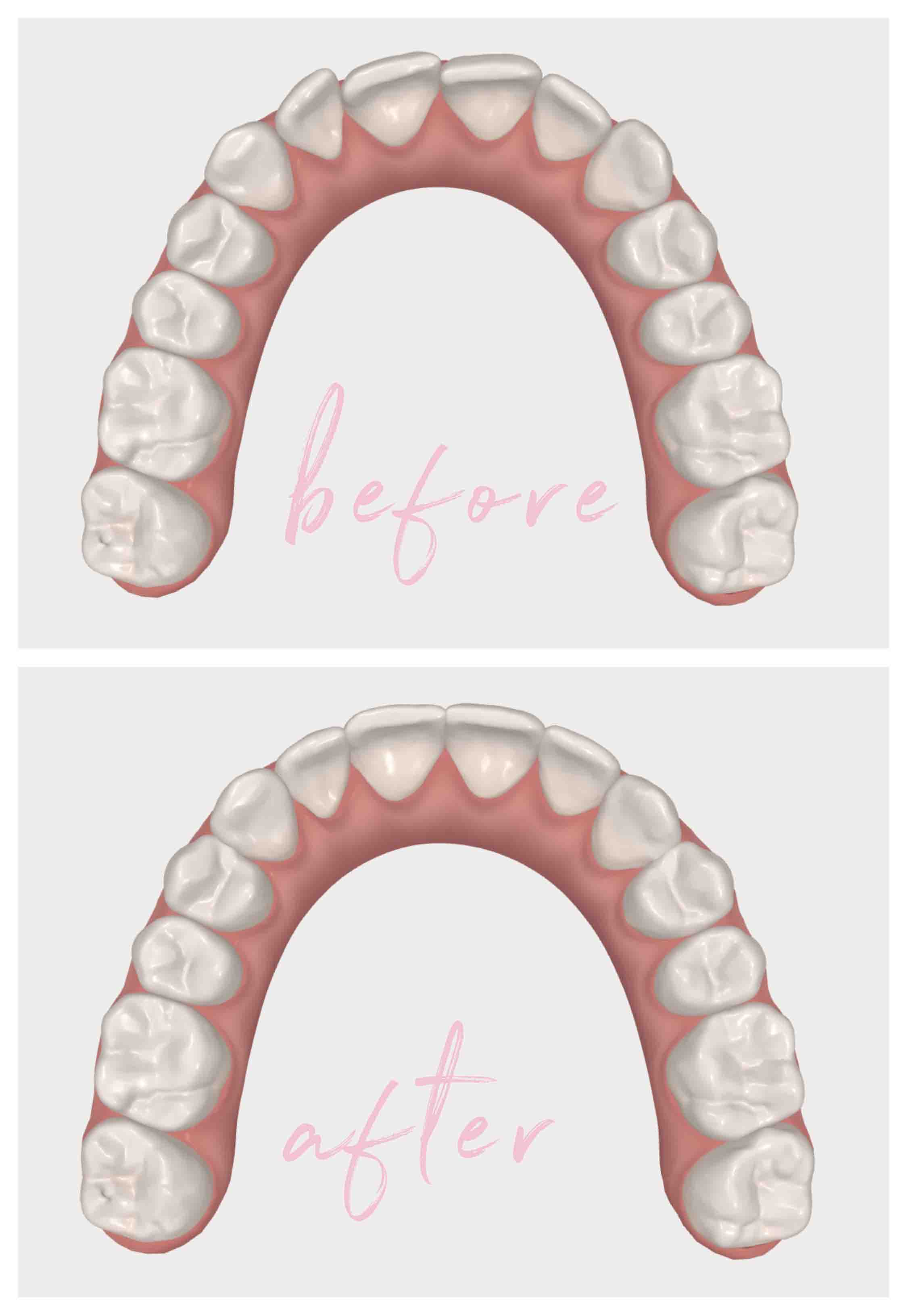 what you need to know about invisalign
